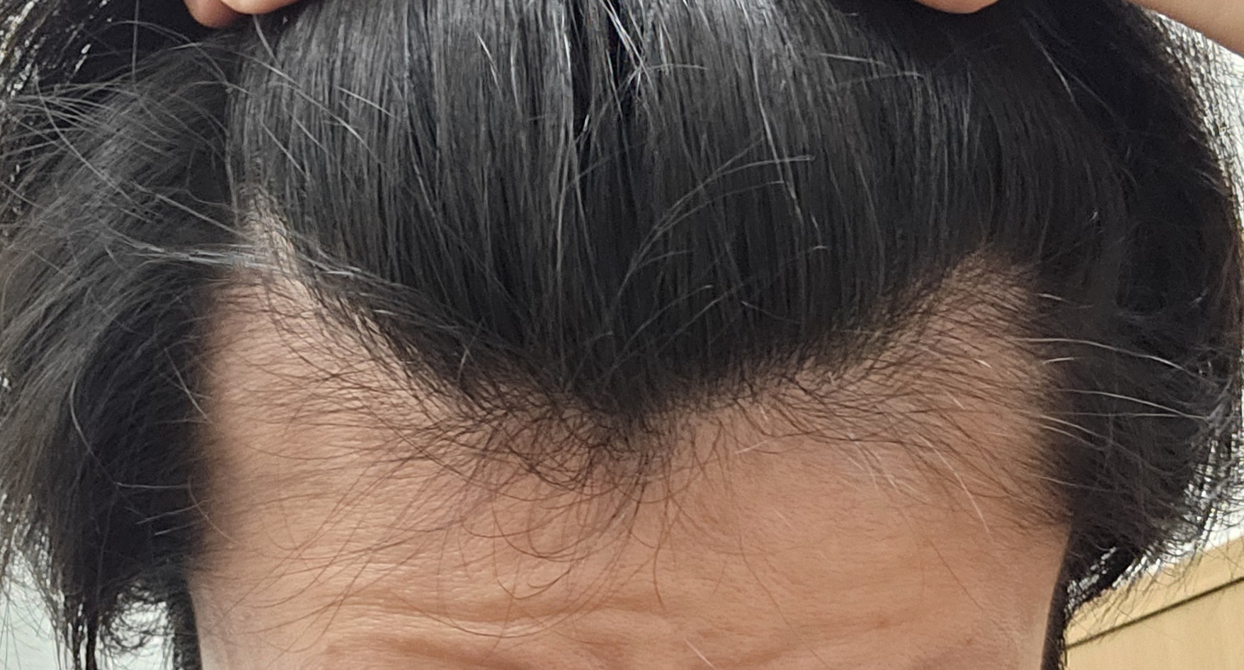 M字の生え際